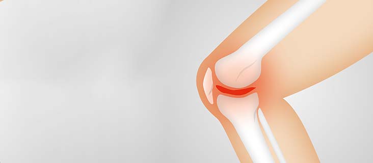 Prevention of Osteoarthritis